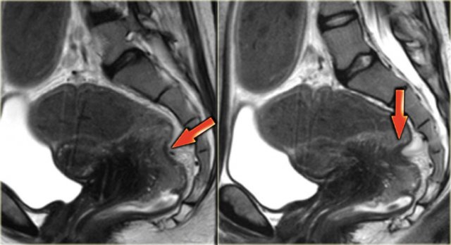 Rectal stenosis due to endometriosis