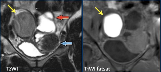 Endometrioma (yellow arrow), hydrosalpynx (red arrow) and leiomyoma (blue arrow).