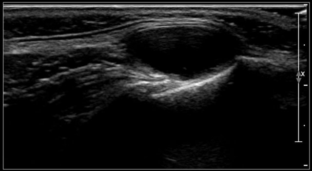 Orbital dermoid cyst