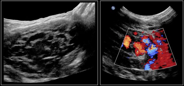 Venous malformation