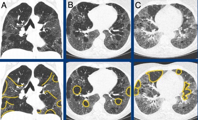 Typical fibrotic hypersensitivity pneumonitis showing diffuse non-basal dominant (A), peribronchial orientated ground-glass and mild fibrotic changes with mosaicism (A and B), and expiratory air trapping (C).