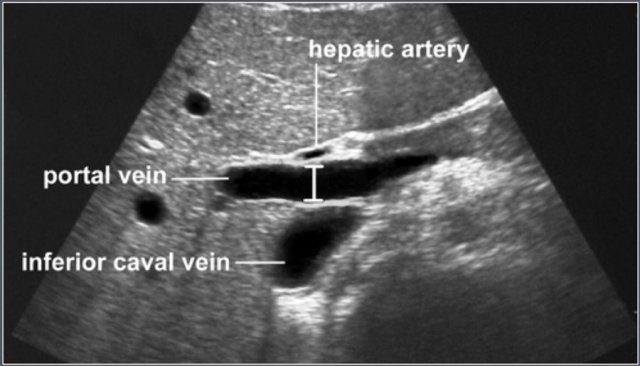 Measurement of portal vein diameter