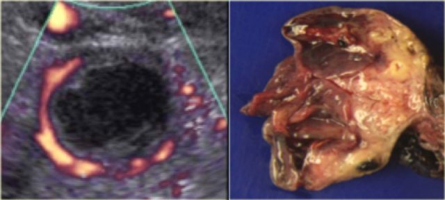 Corpus luteum cyst