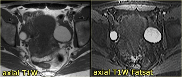 Hemorrhagic ovarian cyst