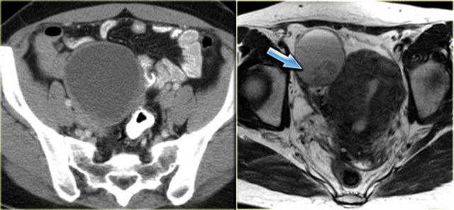 Endometrioma