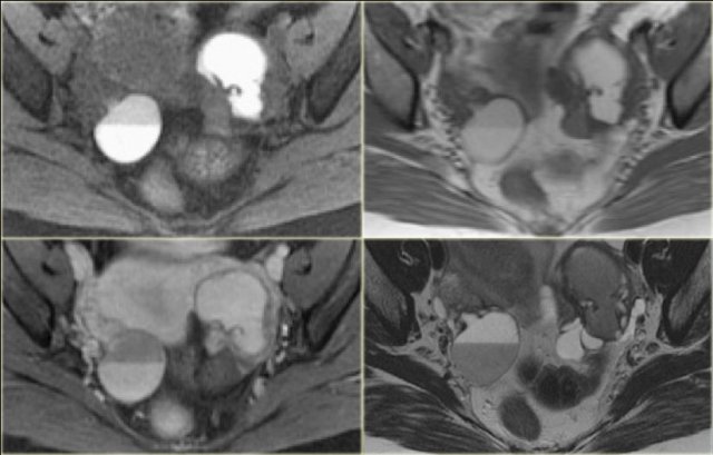 Endometrioma