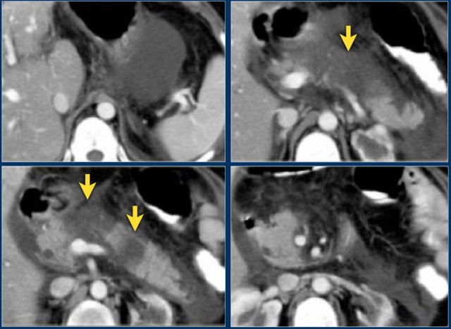 Central gland necrosis with large collections in the left retroperitoneum and lesser sac (ANC's)