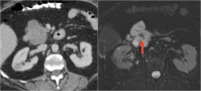 SCN with central scar seen on MRI