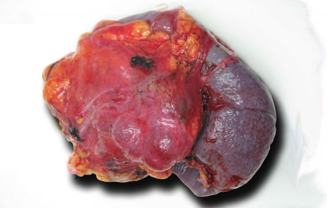 Serous cystic neoplasm.