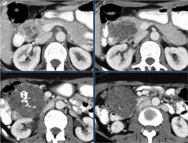 Serous cystic neoplasm