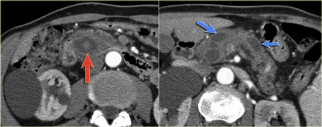 Main duct IPMN with malignant transformation