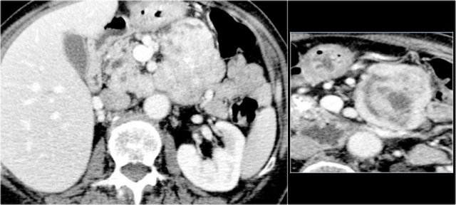 Neuroendocrine tumor with cystic degeneration