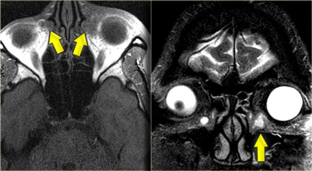 Orbital cellulitis and abscess