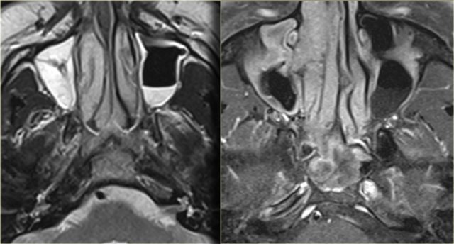 Complicated acute sinusitis