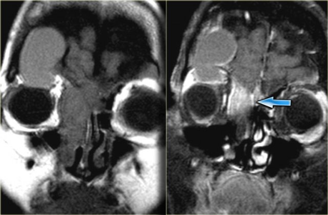 Mucocele secondary to obstructing tumor