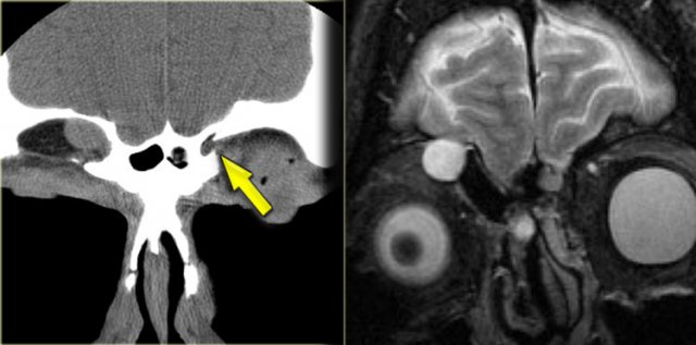 Posttraumatic mucocele and encephalocele