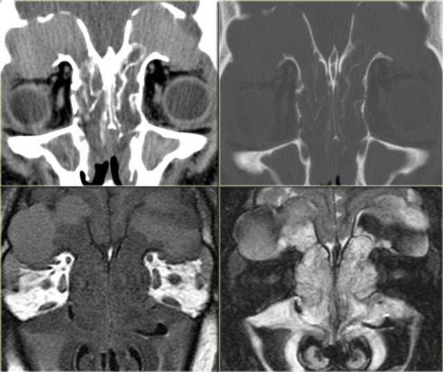 Bilateral mucoceles