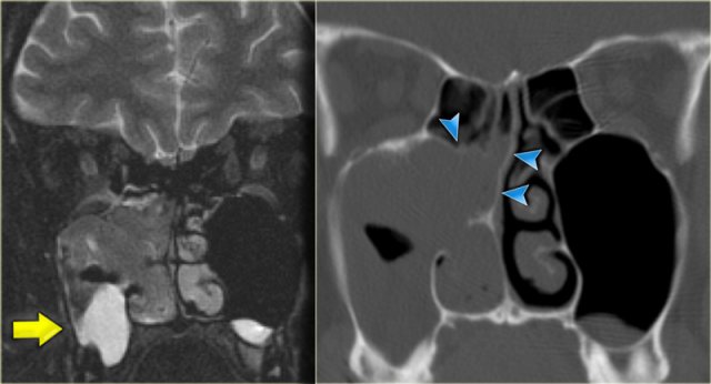 Inverted papilloma in typical location