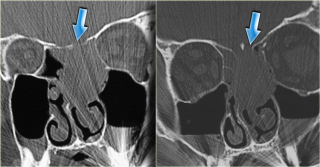 Sinonasal carcinoma