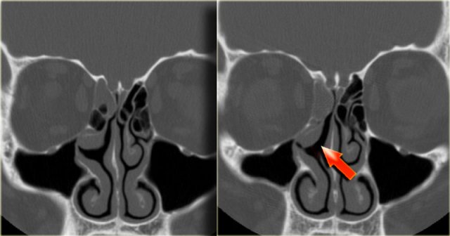 Silent sinus