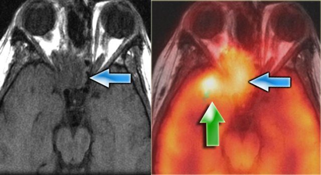 Recurrent sinus carcinoma