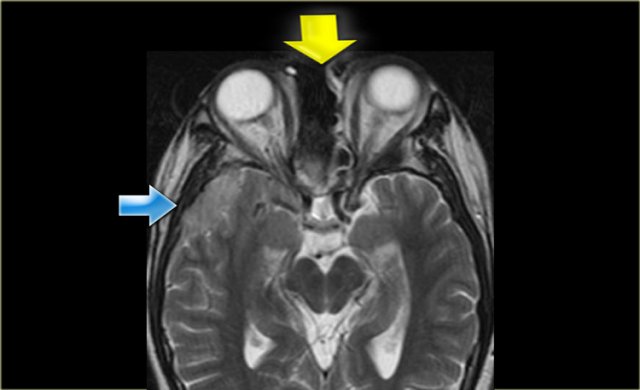 Recurrence of carcinoma with dural implants