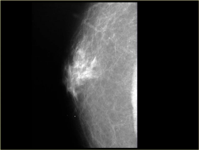 Dendritic pattern of gynecomastia