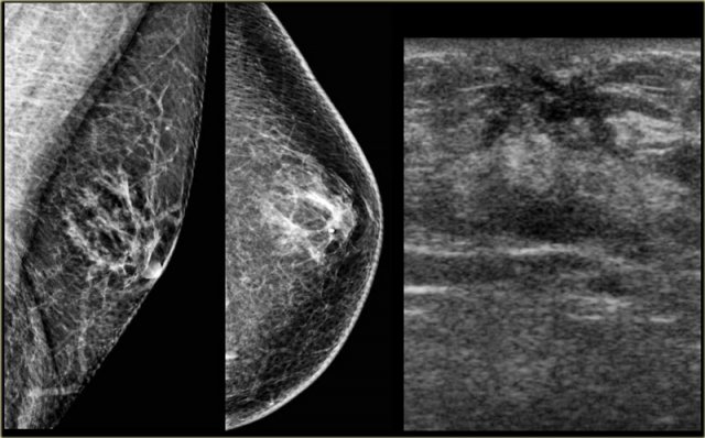 Classic benign chronic gynecomastia