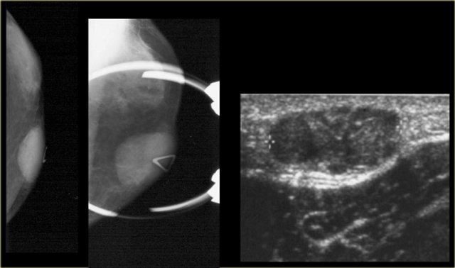 Myofibroblastoma