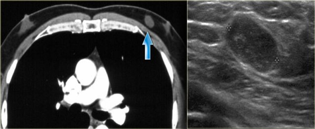 Myofibroblastoma eccentric to the nipple in a patient with a little bit of gynecomastia bilaterally