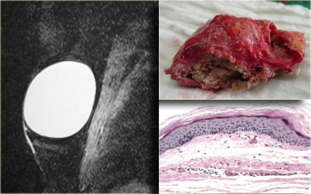 Epidermal inclusion cyst. T2WI with fat sat and pathology