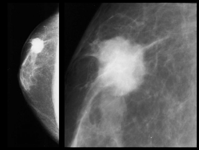 Invasive ductal carcinoma