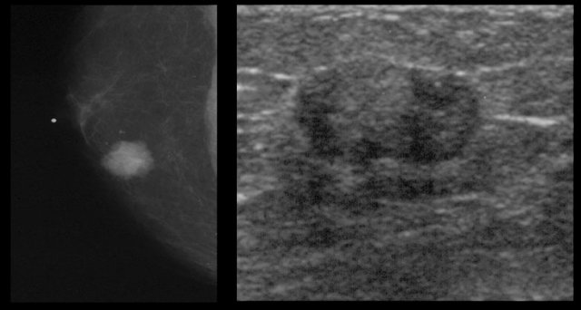 Invasive ductal carcinoma