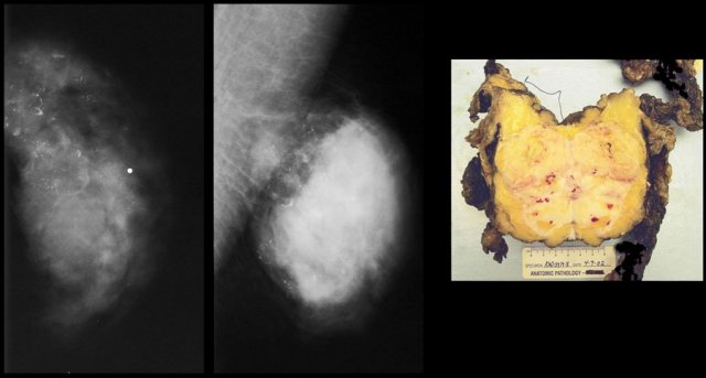 Invasive ductal carcinoma