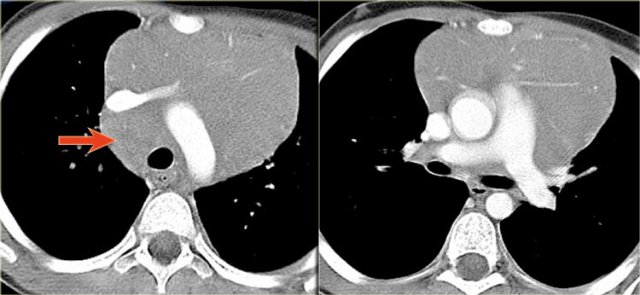 Hodgkin lymphoma