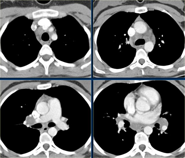 Non-Hodgkin lymphoma