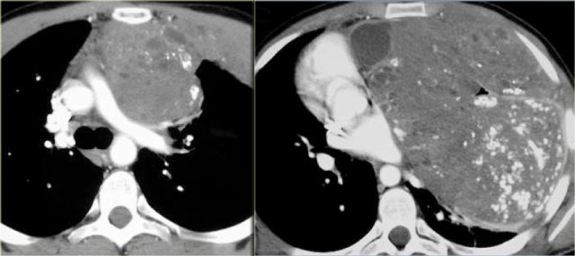 Malignant teratoma