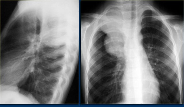 Neuroblastoma presenting as a mass in the posterior mediastinum