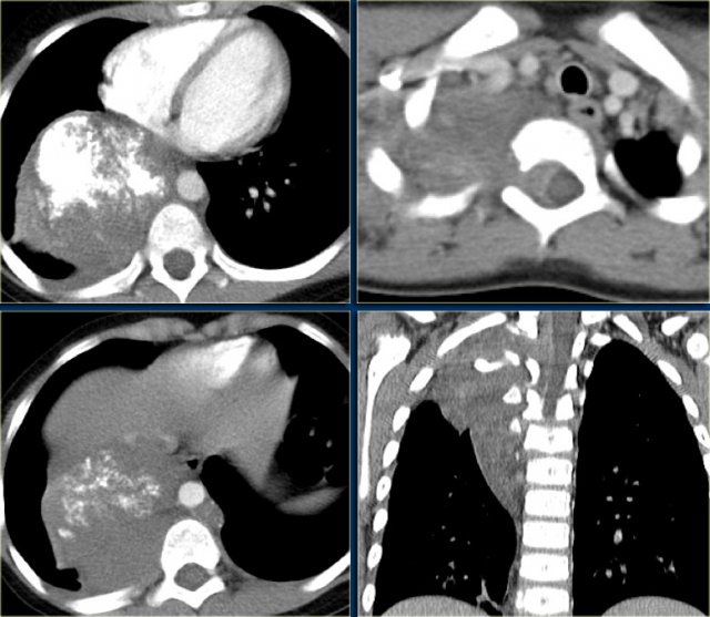 Neuroblastoma