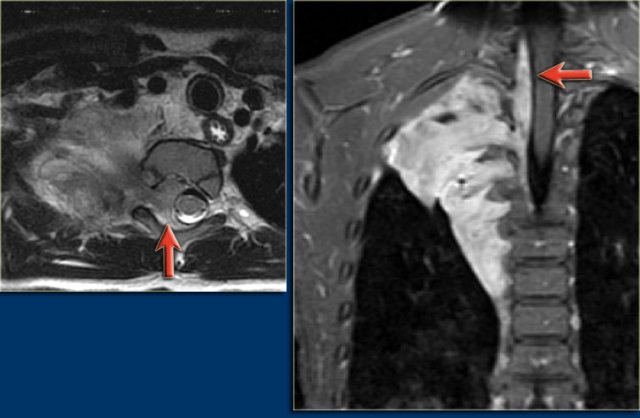 Neuroblastoma