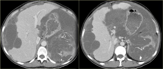 Pseudomyxoma peritonei with pronounced scalloping of the liver and almost destruction of the spleen. Notice the calcifications