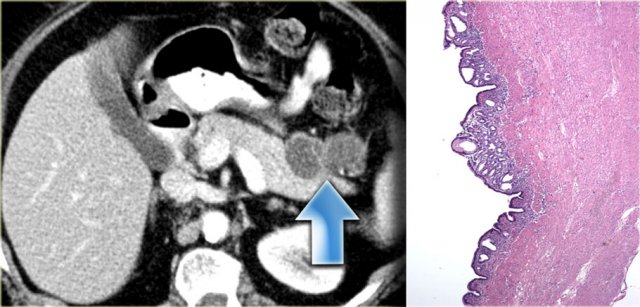 Enteric Duplication Cyst