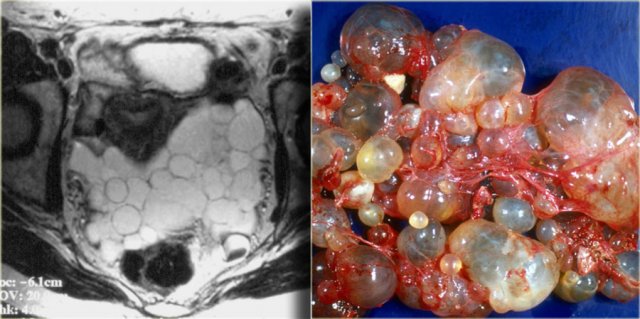 Peritoneal Inclusion Cyst