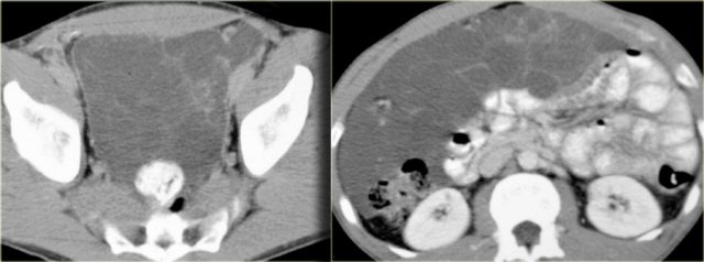 Peritoneal inclusion cyst in a man extending into the upper abdomen