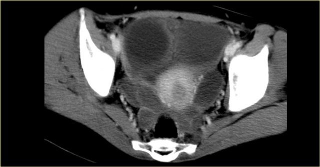 Echinococcal cysts