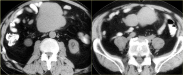 NHL located in the small bowel mesentery