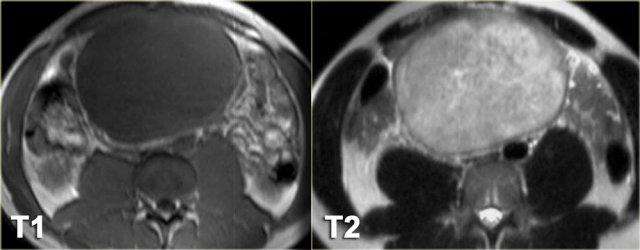 Mesenteric fibromatosiswith high signal on T2WI