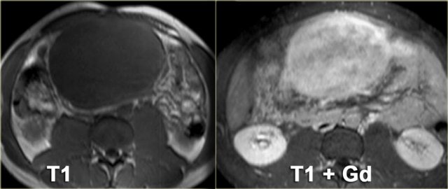 Mesenteric fibromatosis with Gadolinium enhancement