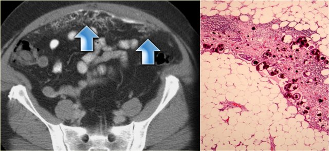 Primary peritoneal serous carcinoma