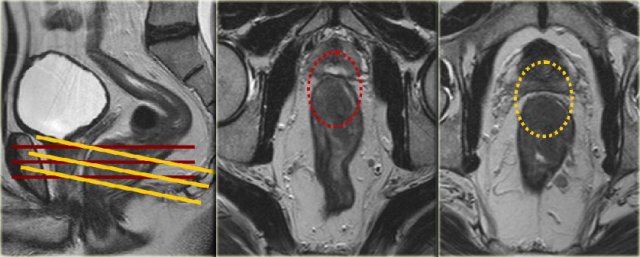 Example of improper angulation. Click to enlarge image